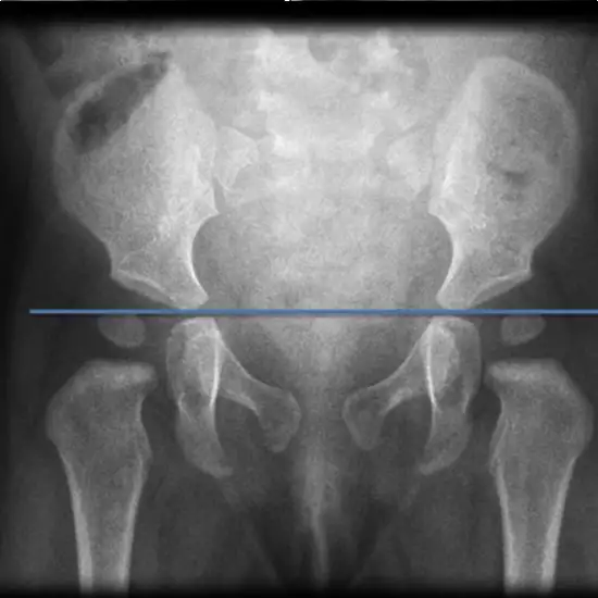 MRI Screening Of Right Hip